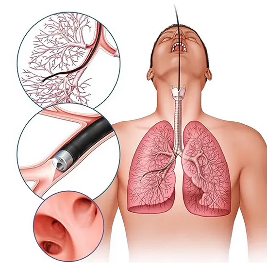 bronchoalveolar lavage examination